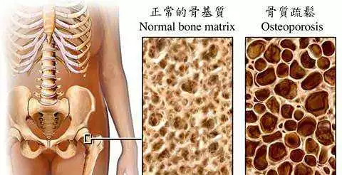 骨质疏松不注意,“浑身骨痛”问题多! 骨质疏松不注意,“浑身骨痛”问题多!