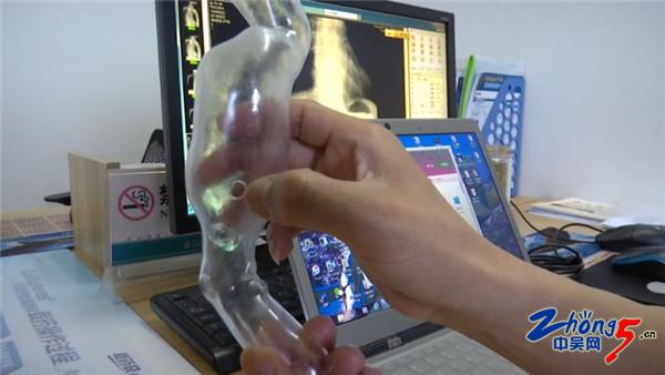 3D打印辅助治疗 提高手术精准性 3D打印辅助治疗 提高手术精准性