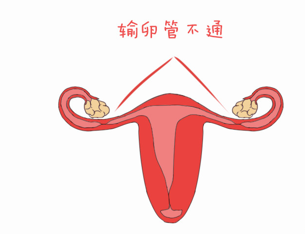 輸卵管雙側都切除