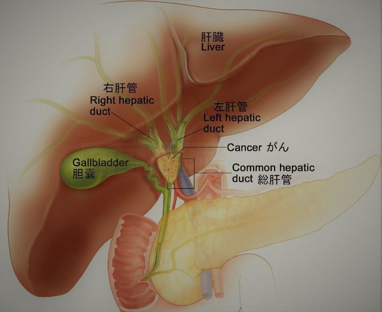 胆管癌90％有胆结石！胆管癌早期难发现但9成有这症状