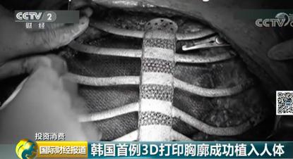 韩国首例3D打印胸廓移植成功!原预计只能活6个月患者:感觉要飞 韩国首例3D打印胸廓移植成功!原预计只能活6个月患者:感觉要飞