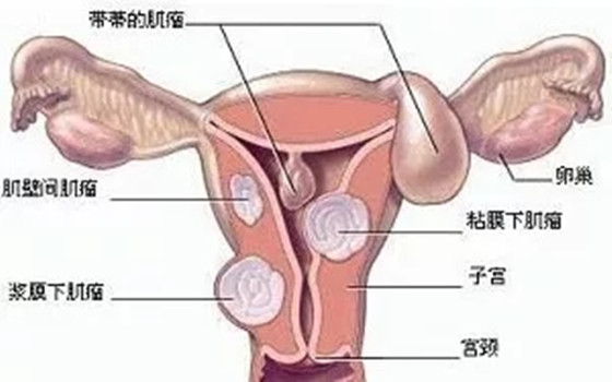 預(yù)防子宮肌瘤需要注意這幾點(diǎn)