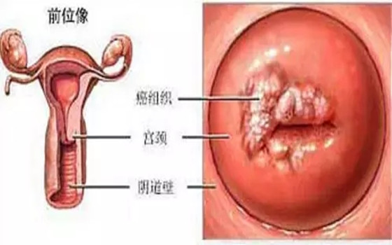 宮頸癌篩查：TCT和HPV怎么選？