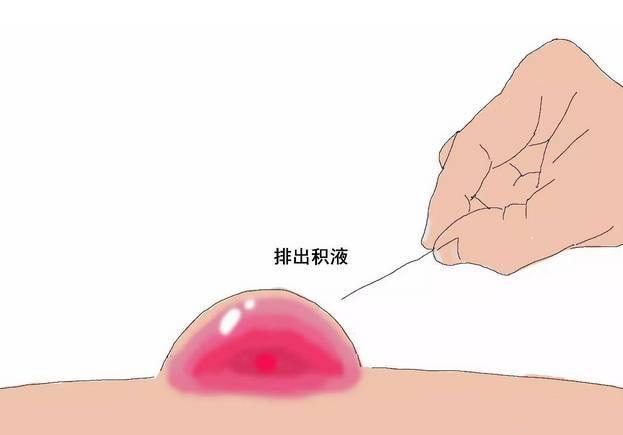 户外拓展徒步训练时双脚起水泡怎么办? 户外拓展徒步训练时双脚起水泡怎么办?