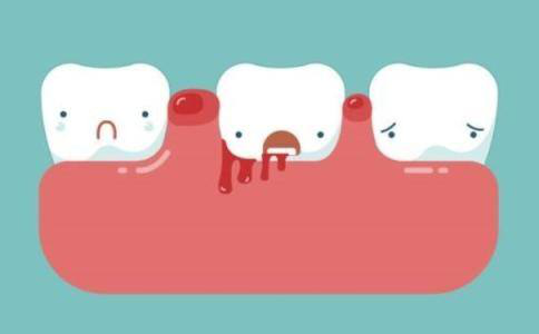 深圳口腔医院专家： 牙周炎的发病原因和四大症状