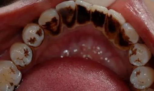牙黄是哪些因素导致的？
