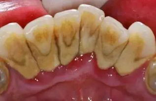 牙黄是哪些因素导致的？