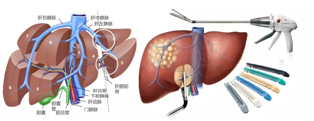 腹腔鏡肝左外葉切除示意圖.