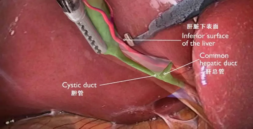 【腹腔镜篇】胆囊切除关键解剖结构 【腹腔镜篇】胆囊切除关键解剖结构