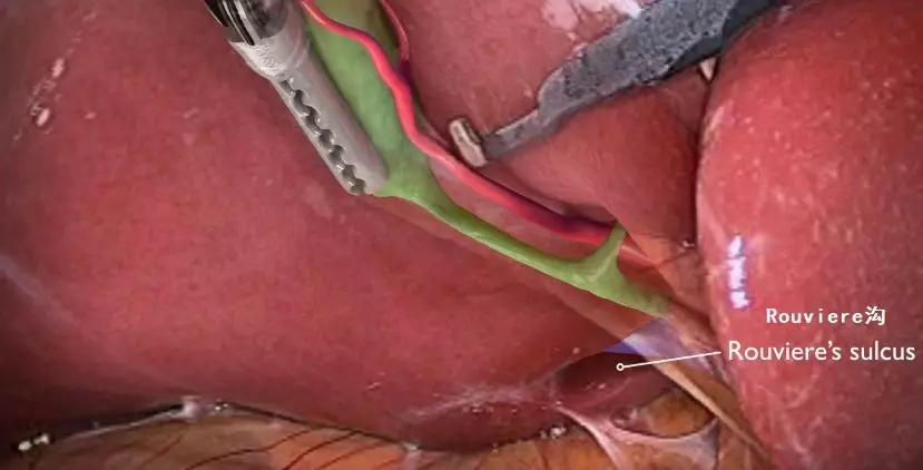 【腹腔镜篇】胆囊切除关键解剖结构 【腹腔镜篇】胆囊切除关键解剖结构
