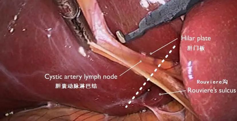 【腹腔镜篇】胆囊切除关键解剖结构