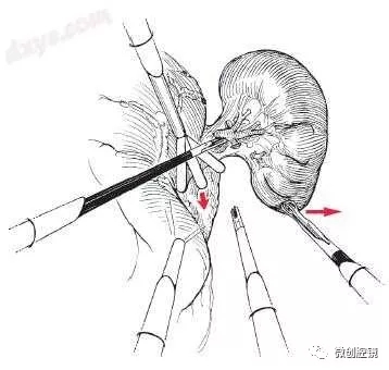 【腹腔镜篇】脾切除手术的技巧 【腹腔镜篇】脾切除手术的技巧