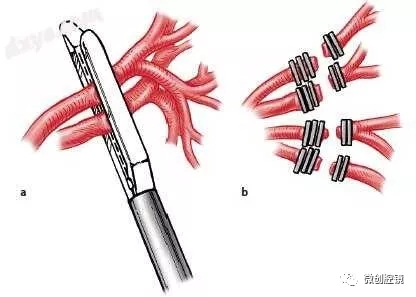 【腹腔镜篇】脾切除手术的技巧 【腹腔镜篇】脾切除手术的技巧