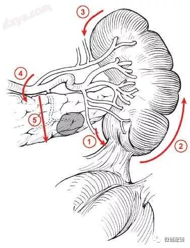 【腹腔镜篇】脾切除手术的技巧 【腹腔镜篇】脾切除手术的技巧