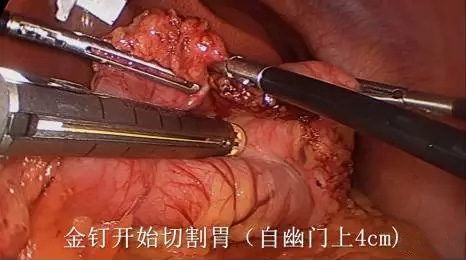 【腹腔镜篇】减重手术 【腹腔镜篇】减重手术