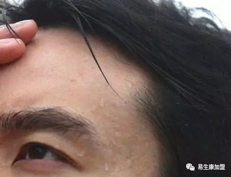 怎样解决常见的虚汗问题? 怎样解决常见的虚汗问题?