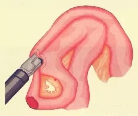 【腹腔镜篇】小肠手术 【腹腔镜篇】小肠手术