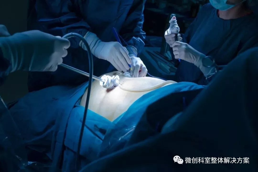 【腹腔镜篇】巨大肝囊肿开窗 【腹腔镜篇】巨大肝囊肿开窗