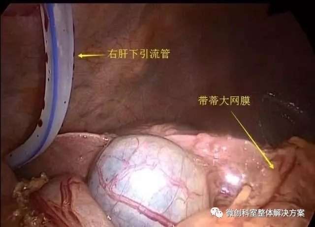 【腹腔镜篇】巨大肝囊肿开窗 【腹腔镜篇】巨大肝囊肿开窗