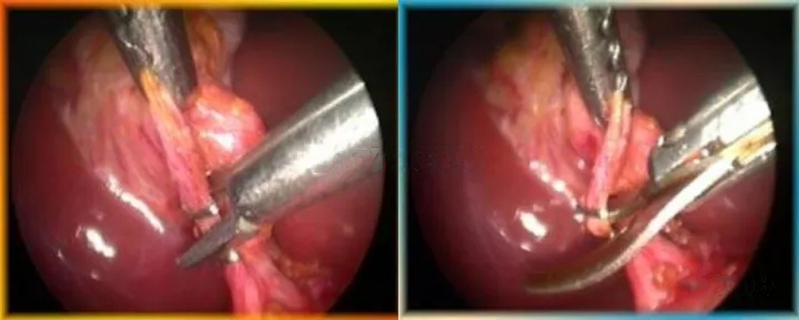 【腹腔镜篇】缝合与打结技巧 【腹腔镜篇】缝合与打结技巧