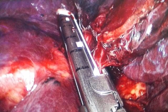 【腹腔镜篇】缝合与打结技巧 【腹腔镜篇】缝合与打结技巧
