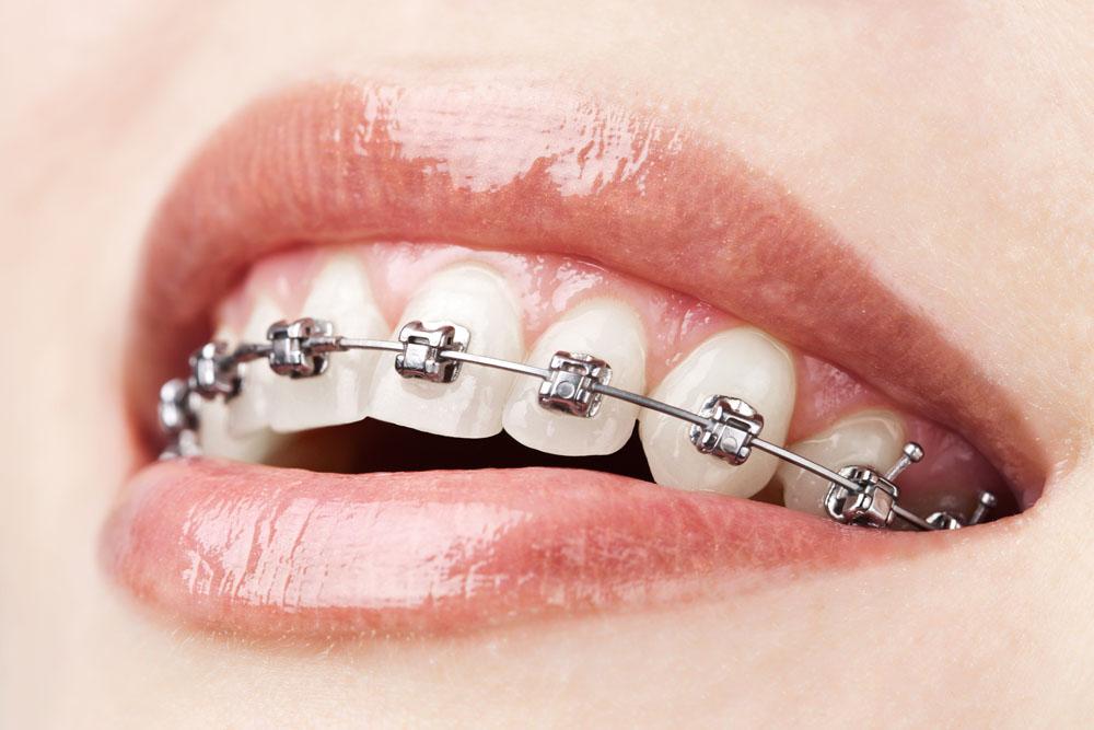 在深圳牙齿矫正后会导致法令纹变深吗？
