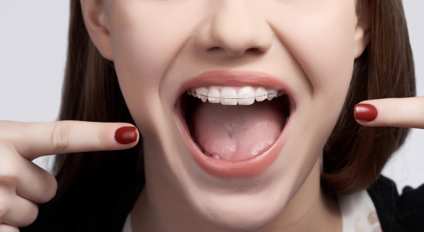 深圳牙齿矫正丨不允许你错过这么实用的“牙套脸”急救法！