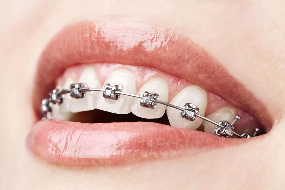 牙齿矫正越贵，效果越好吗？