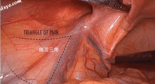 【腹腔镜篇】腹股沟结构解剖