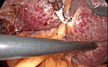 【腹腔镜篇】肝切除术入路 【腹腔镜篇】肝切除术入路
