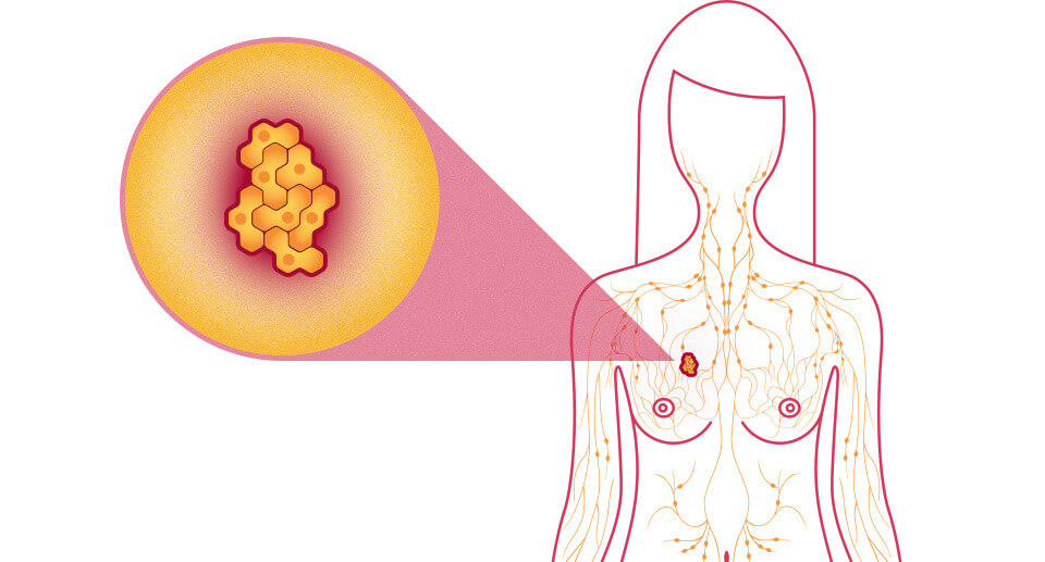 贝斯曼乳腺自查仪,母亲、护士们预防乳腺疾病的好帮手 贝斯曼乳腺自查仪,母亲、护士们预防乳腺疾病的好帮手
