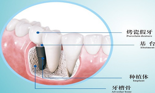 在深圳牙科医院做种植牙需要注意什么