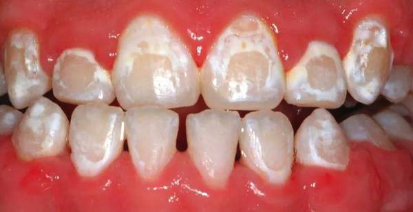 深圳牙齿矫正：我不敢矫正牙齿，怕有副作用！？