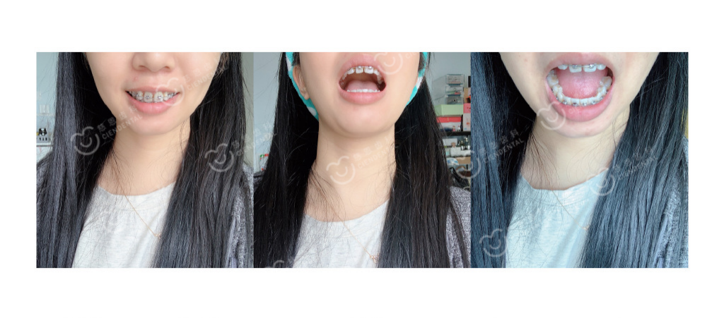 深圳牙齿矫正丨拥挤不齐、嘴突、没下巴一次解决是种什么体验？！