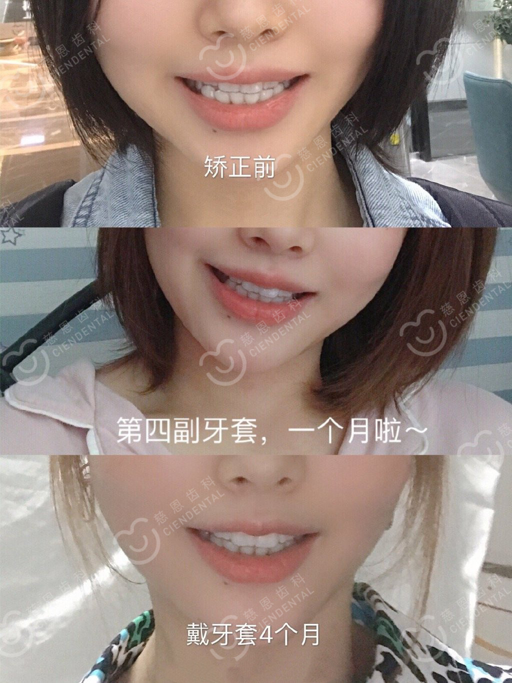 深圳牙齿矫正 | 患者投稿:那些在矫正牙齿的人,经历了什么? 深圳牙齿矫正 | 患者投稿:那些在矫正牙齿的人,经历了什么?