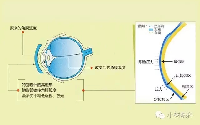 角膜塑形镜就是OK镜吗? 角膜塑形镜就是OK镜吗?