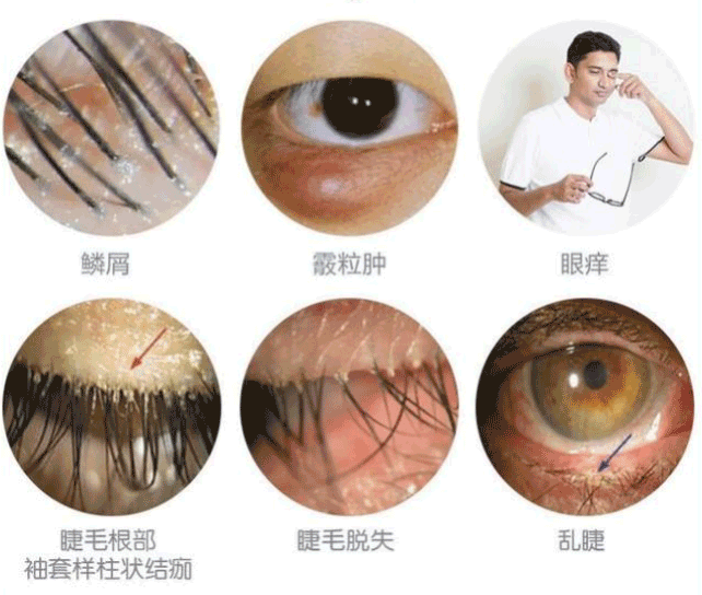 螨虫如何感染,如何治疗? 螨虫如何感染,如何治疗?