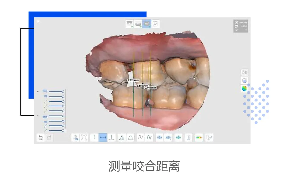 【病例报告】数字化印模技术在高嵌体修复病例中的应用