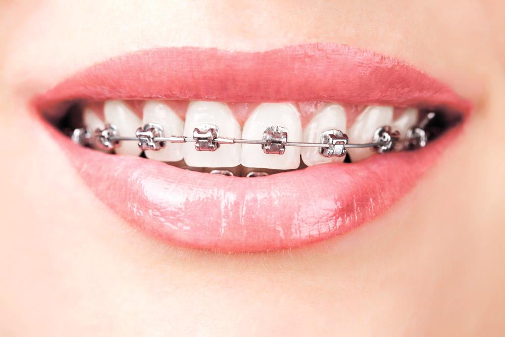 在深圳牙齿矫正需要拔牙吗？