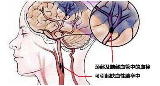 从25岁到75岁，中风都是你的“头号杀手”