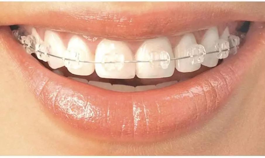 在深圳牙齿矫正时为什么需要挂橡皮筋呢？