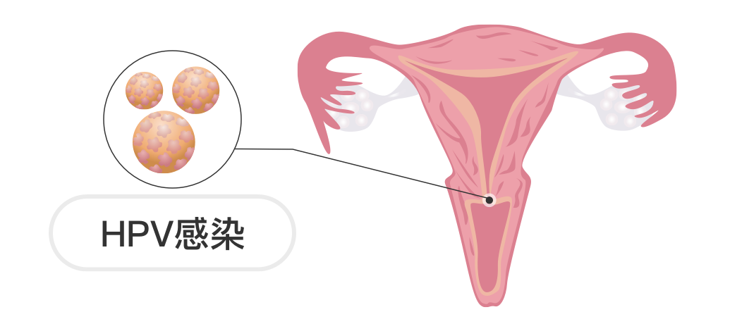 癌症会传染？坦白说：不会！但致癌病毒要警惕...