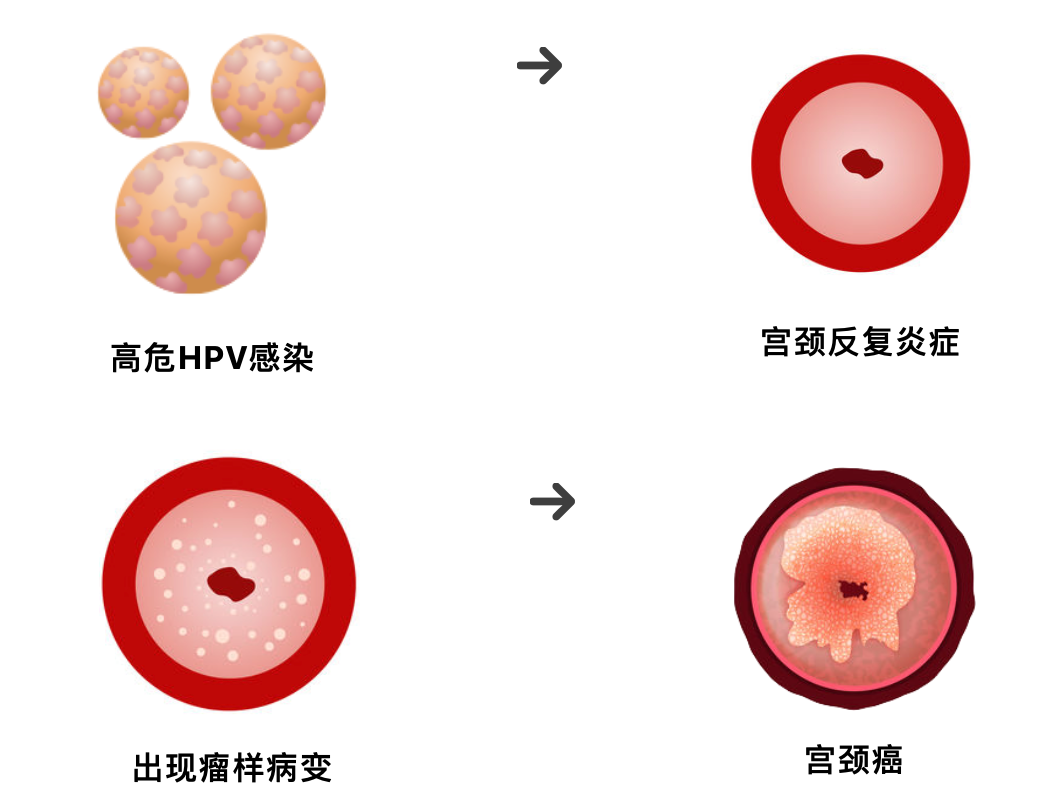 癌症会传染？坦白说：不会！但致癌病毒要警惕...