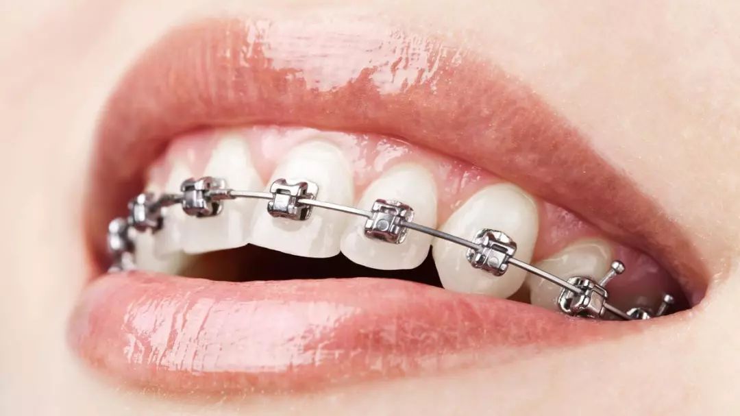 在深圳牙齿矫正时金属自锁牙套有哪些优势
