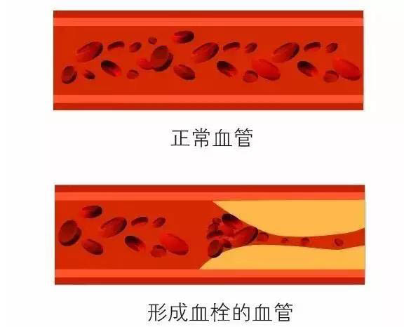 好好的血管怎么就堵了呢？预防血栓，做好这件事很重要！
