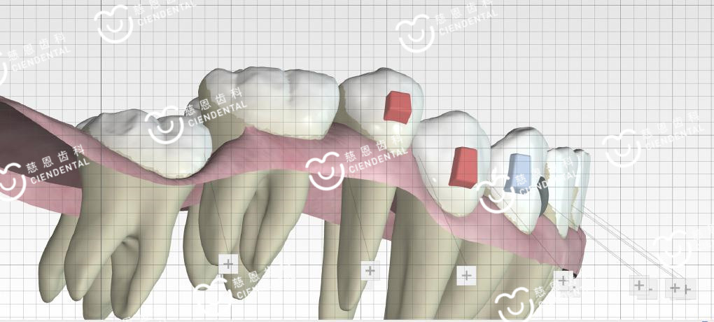 牙根短能在深圳牙齿矫正吗