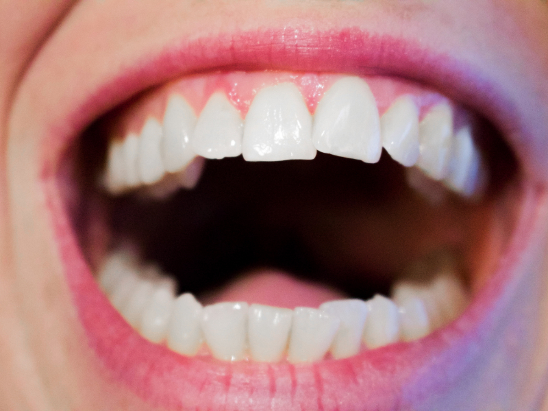 哪些情况下需要到深圳牙齿矫正机构进行牙齿矫正？