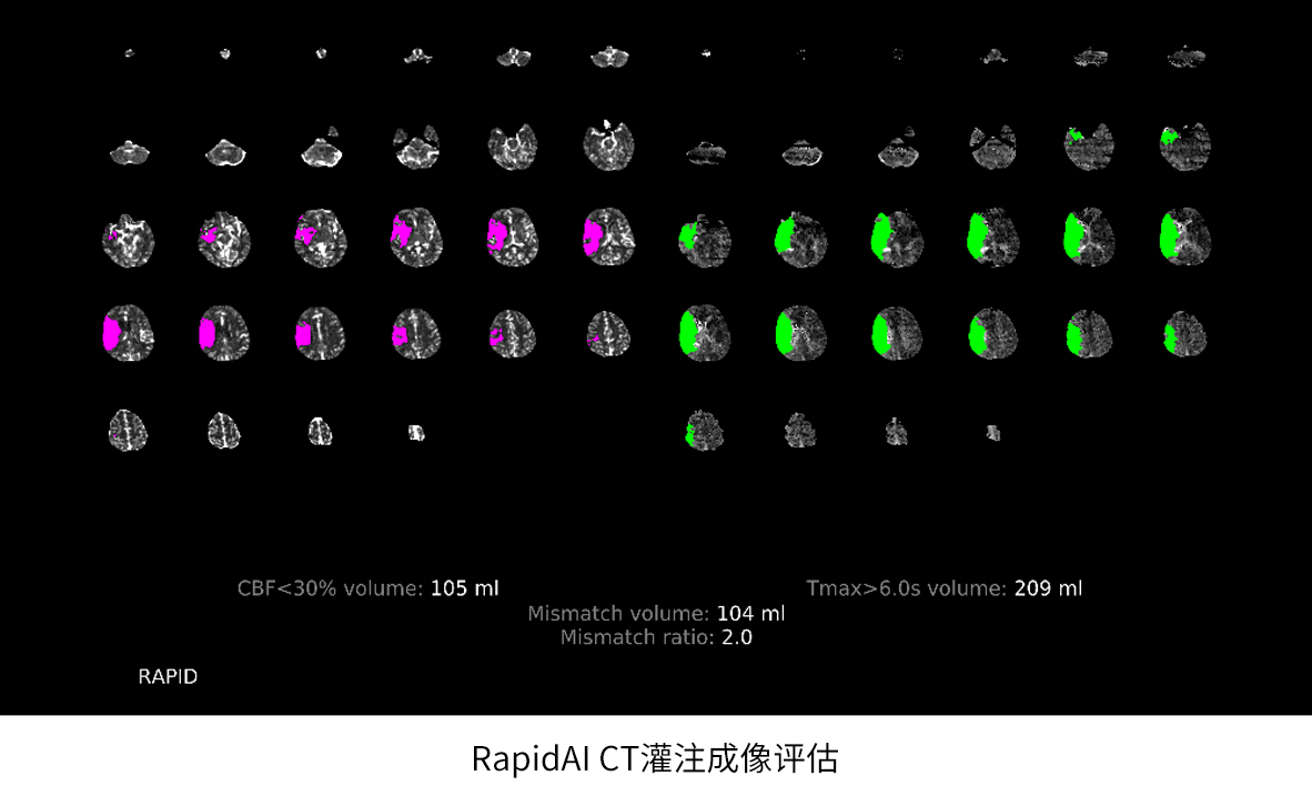 卒中救治2.0时代|泓懿医疗携手GE医疗,共创脑卒中AI诊断新里程 卒中救治2.0时代|泓懿医疗携手GE医疗,共创脑卒中AI诊断新里程