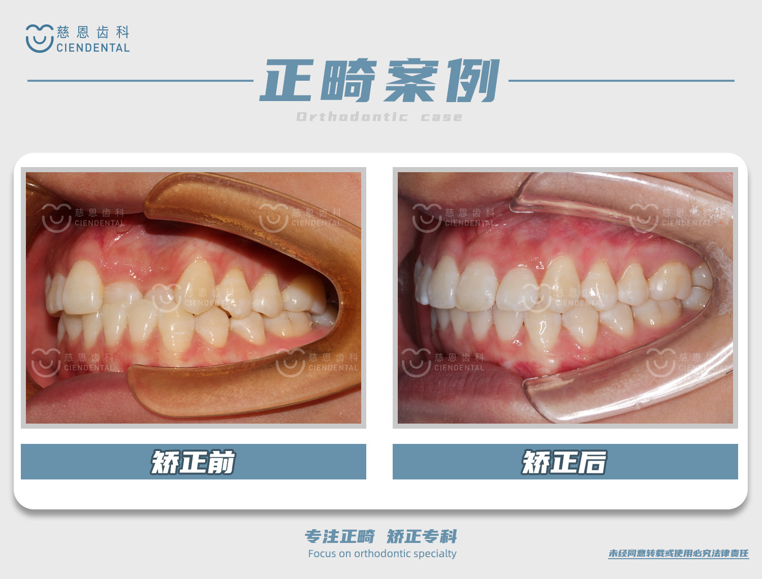 陈江山医生牙齿矫正案例