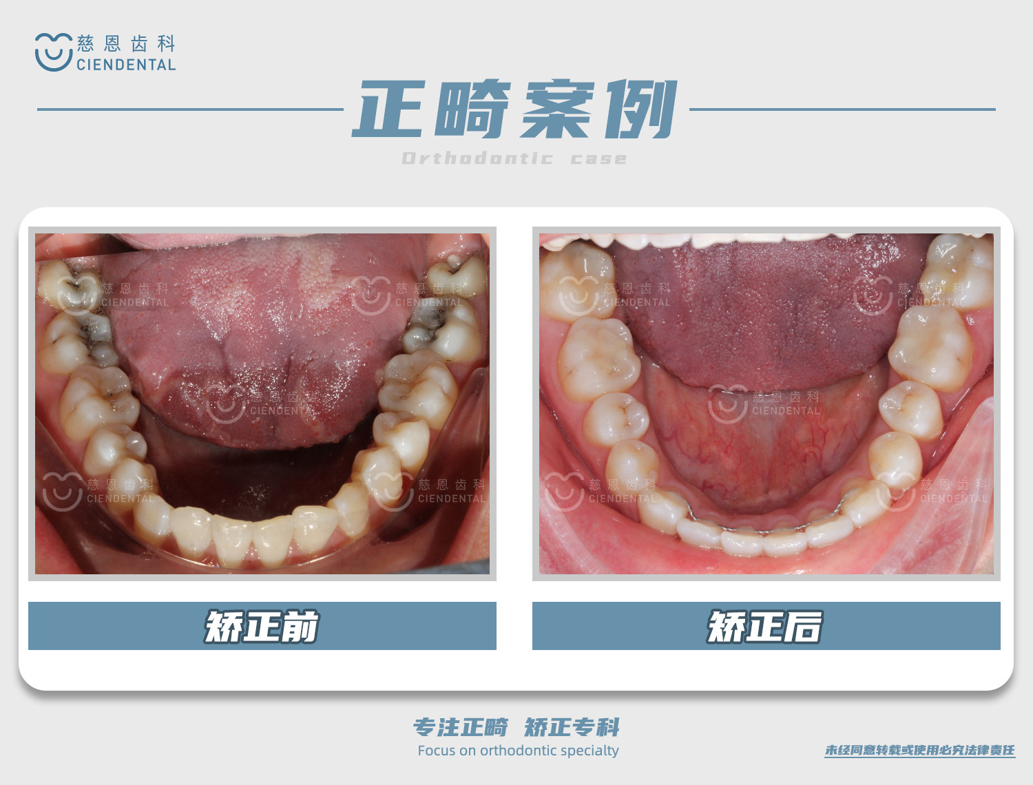 陈江山医生牙齿矫正案例